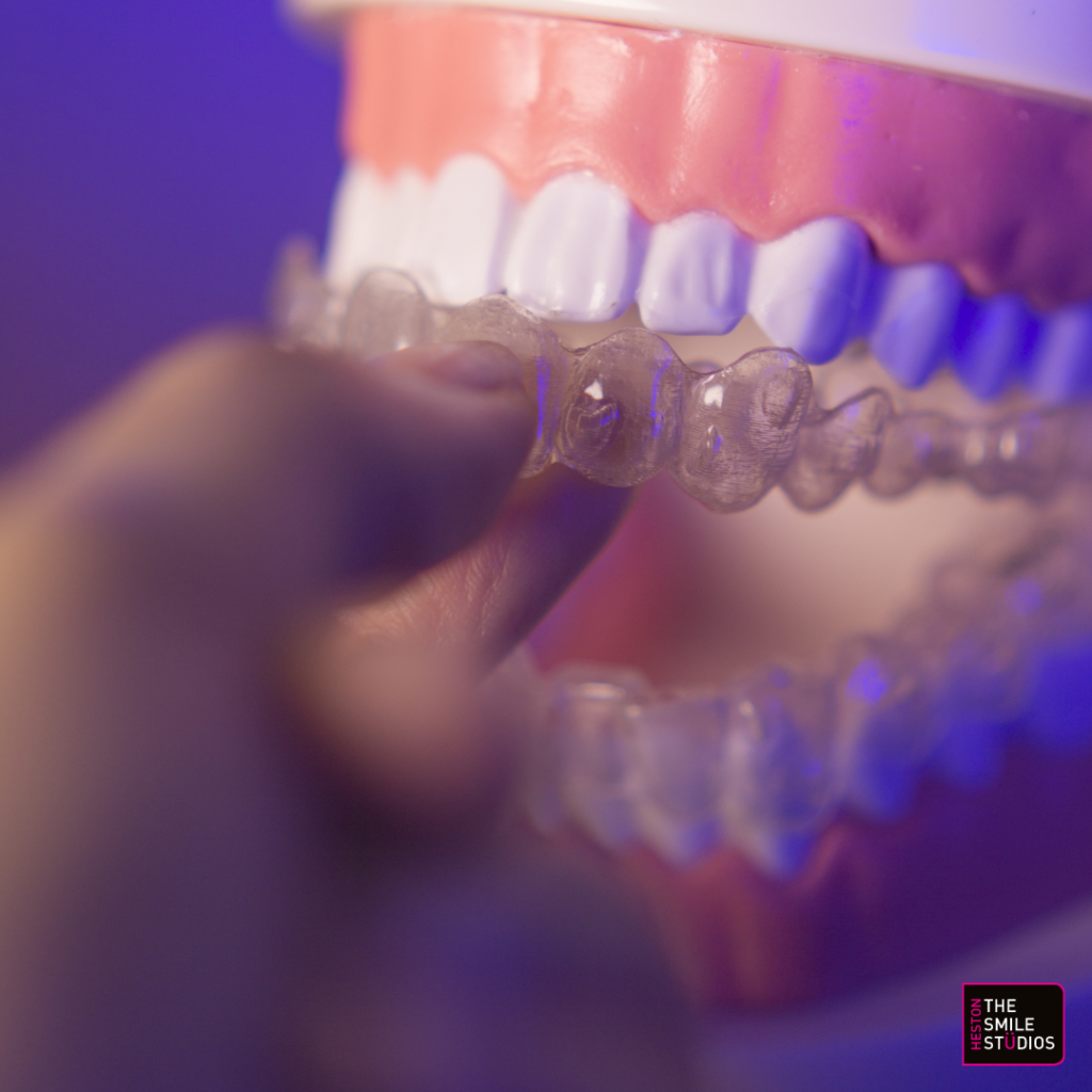 Model of a set of teeth mouth open. Invisalign aligner is placed over the top. 