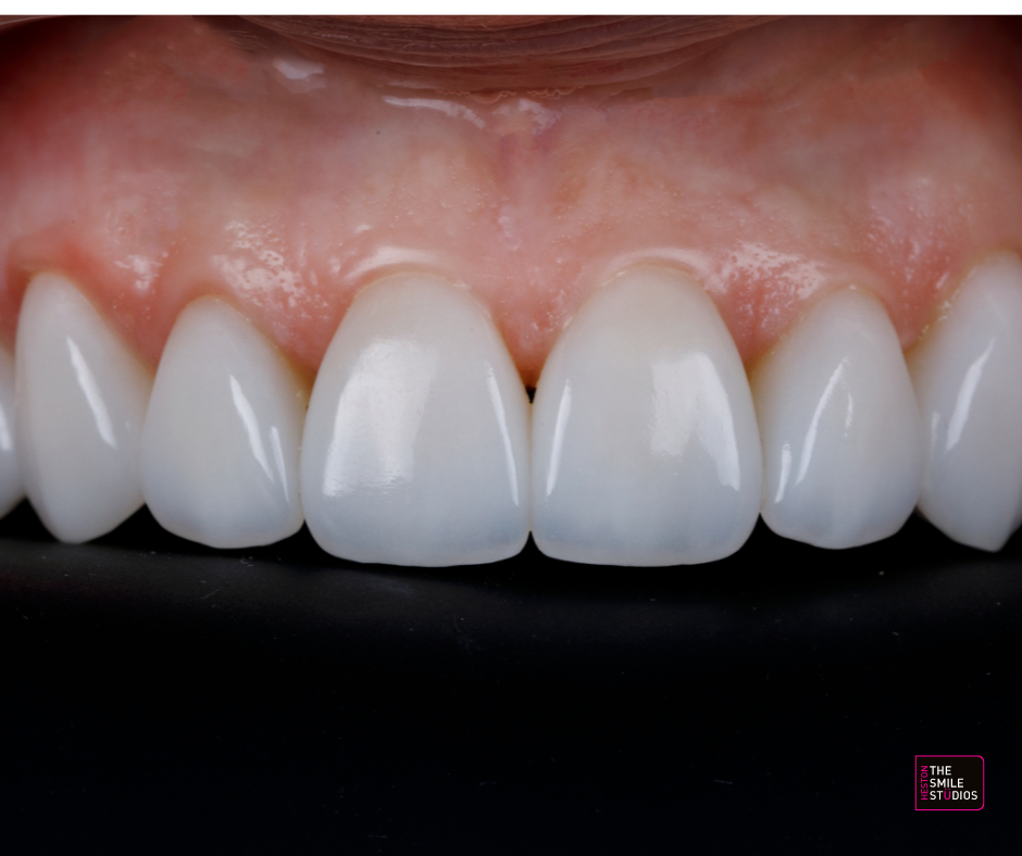 Close up of a set of porcelain veneers. 